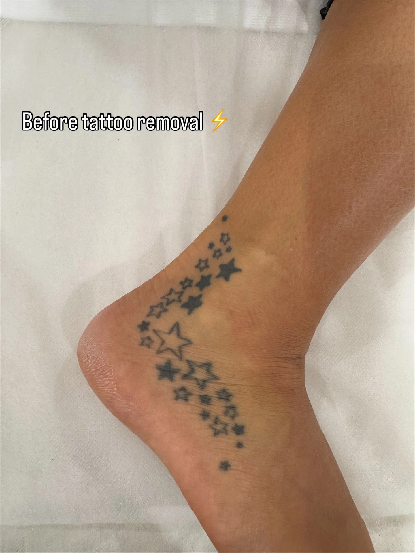 Tattoo Removal ✨ before ➡️ after updates!! 

It&rsquo;s all about the journey 🤭 

www.onlylaser.com.au