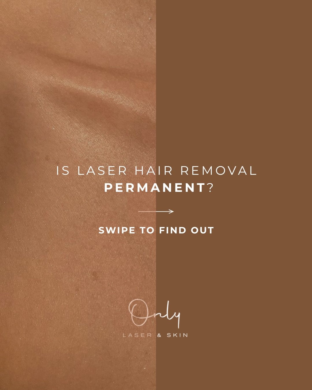 Swipe &rarr; Myth or Fact 👀

Many people think laser hair removal removes every hair forever. 

The truth? It&rsquo;s best described as long-term hair reduction ✨

www.onlylaser.com.au