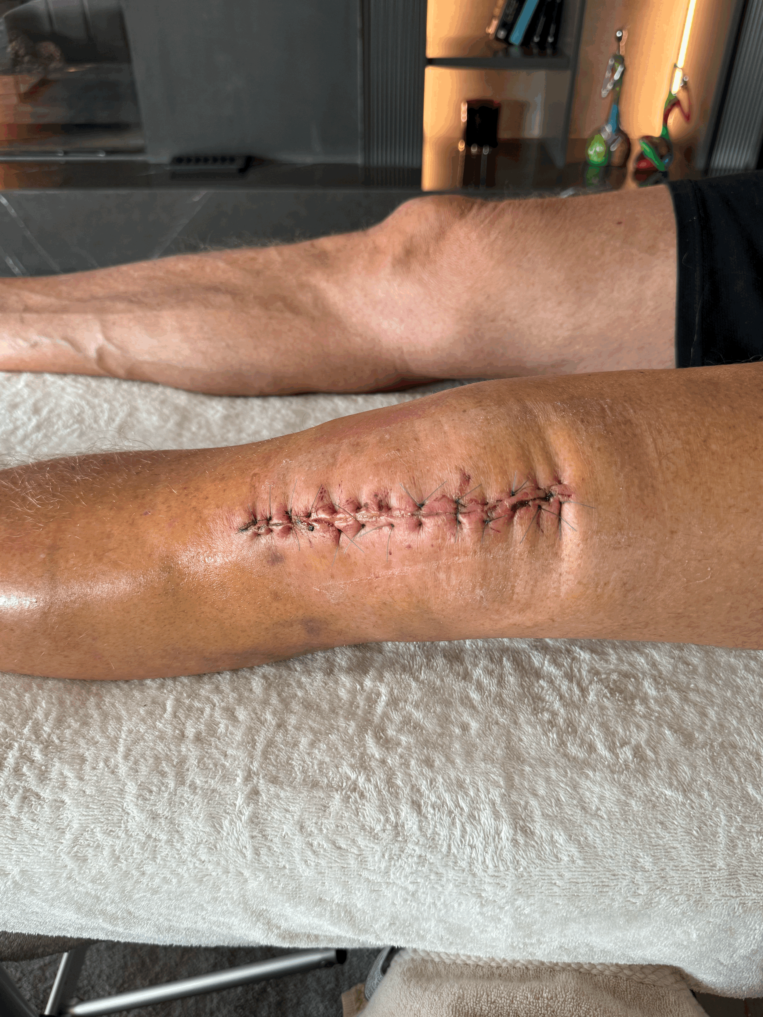 rehabilitación de PRÓTESIS DE RODILLA