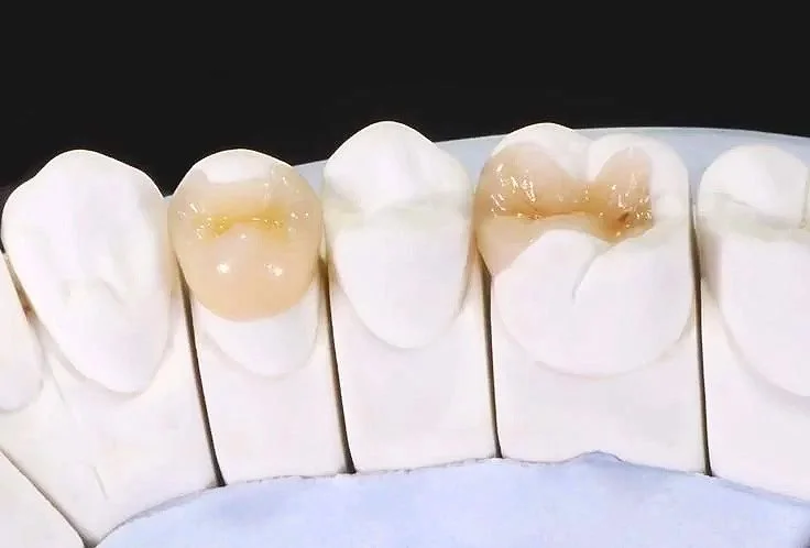 Modèle dentaire avec cinq dents, dont deux restaurées avec des amalgames en or.