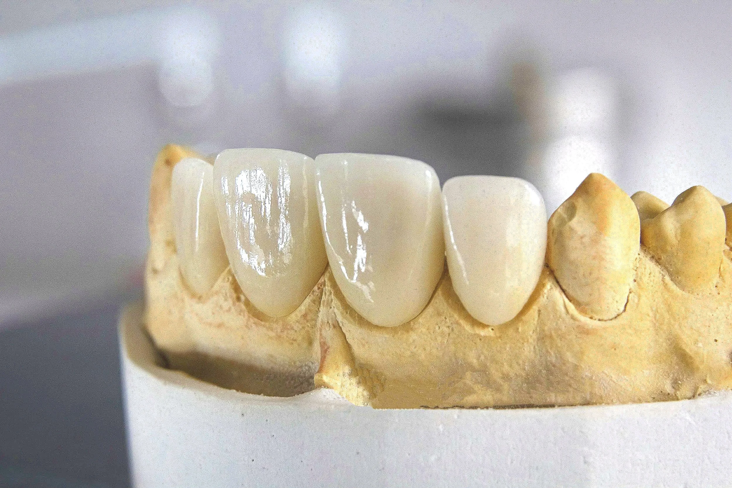 Modèle de dents en céramique sur une base en cire, destiné à la dentisterie restorative.