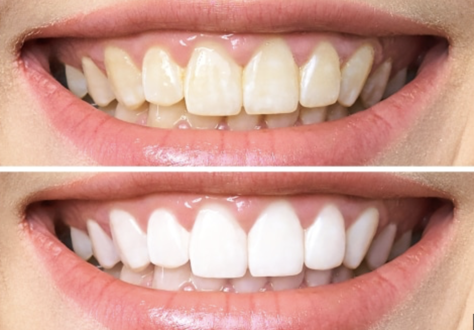 Comparaison d'un sourire avant et après un traitement d'éclaircissement des dents, montrant des dents jaunes puis blanches.