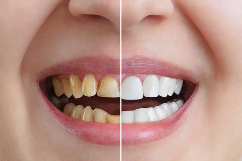 Comparaison de dents jaunies et tachées à des dents blanches et saines après un traitement dentaire.