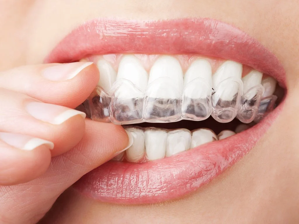 Une personne appliquant un protège-dents transparent sur ses dents.