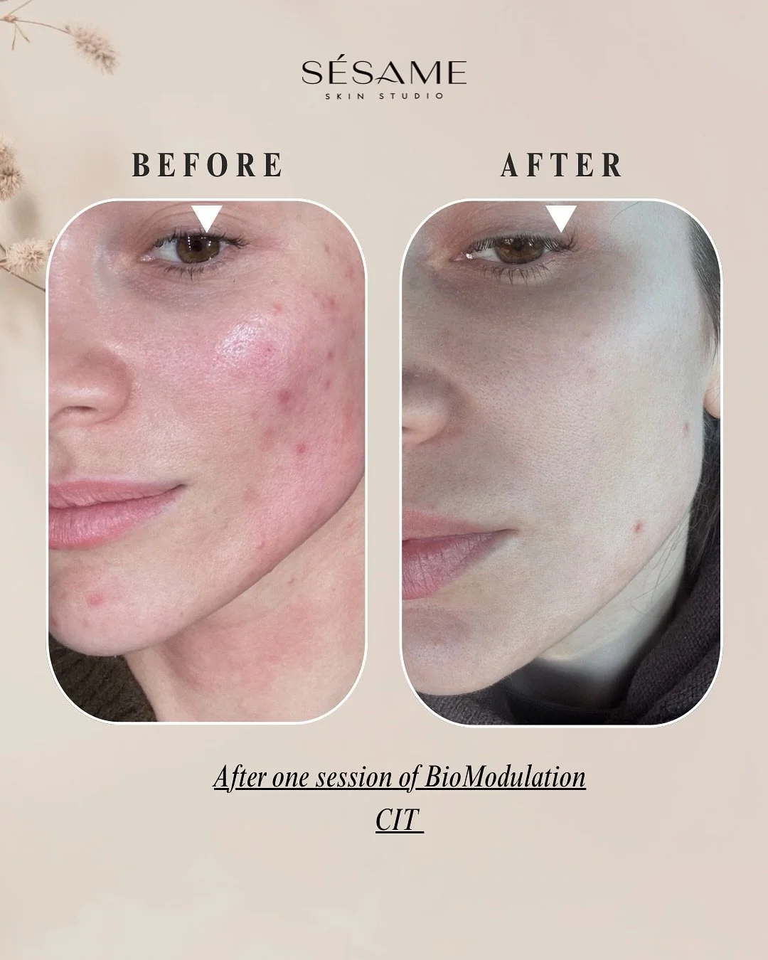 Think Microneedling, but Gel- Natural Form ✨ 

@glycoala_usa 

I&rsquo;m so proud to bring this treatment to Sesame Skin Studio. It&rsquo;s deeply restorative, science-driven, and perfect for anyone wanting results without downtime. Your skin deserve