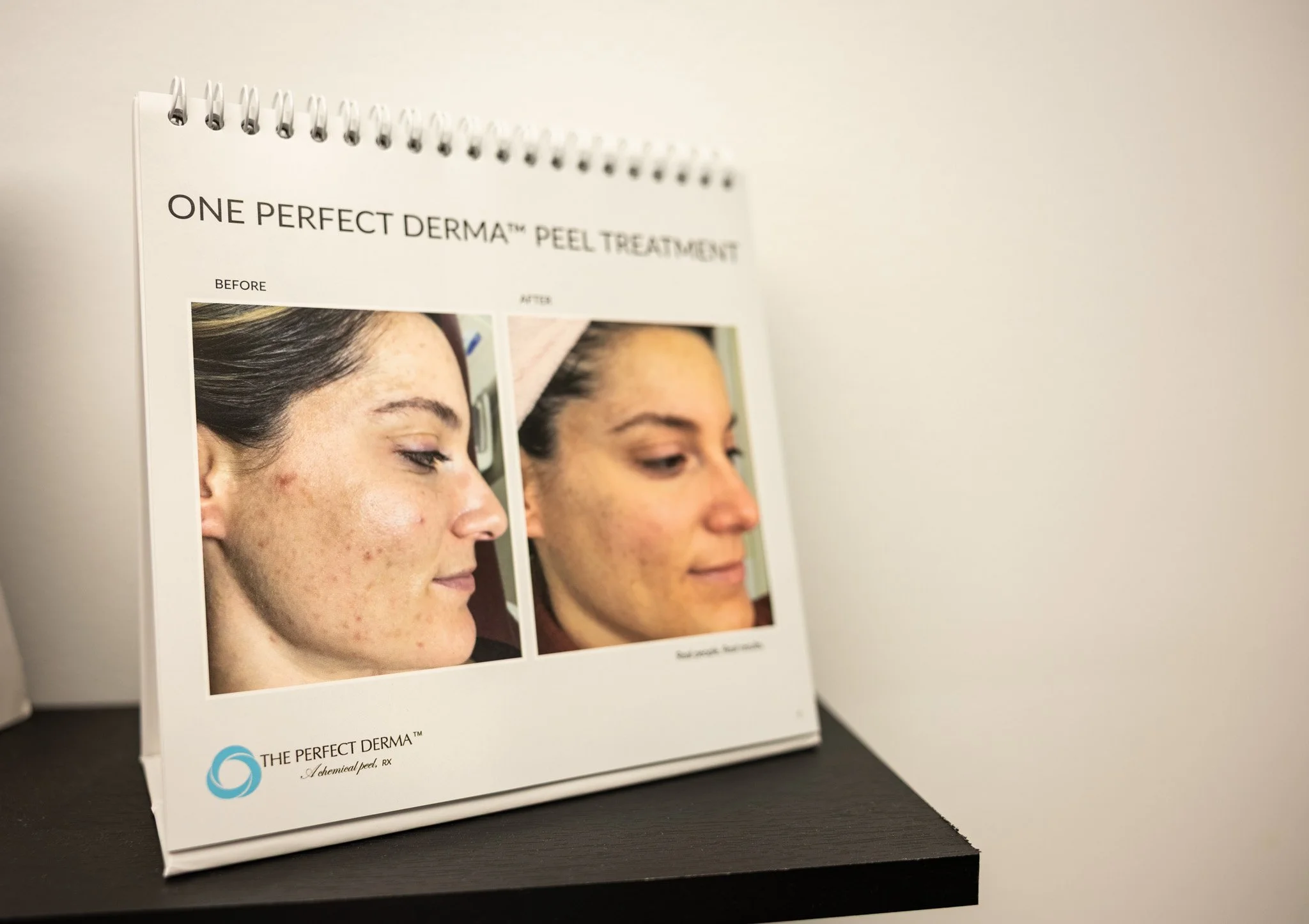 Chemical peels at Buff Aesthetics in Tiffin, Ohio