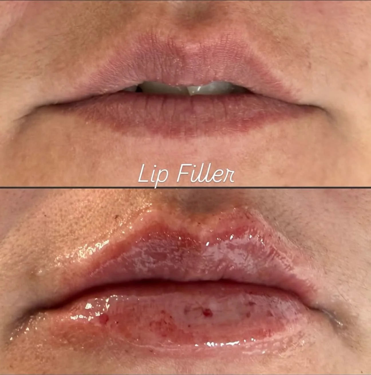 Before and after image of a lip enhancement procedure at Buff Aesthetics in Tiffin, OH