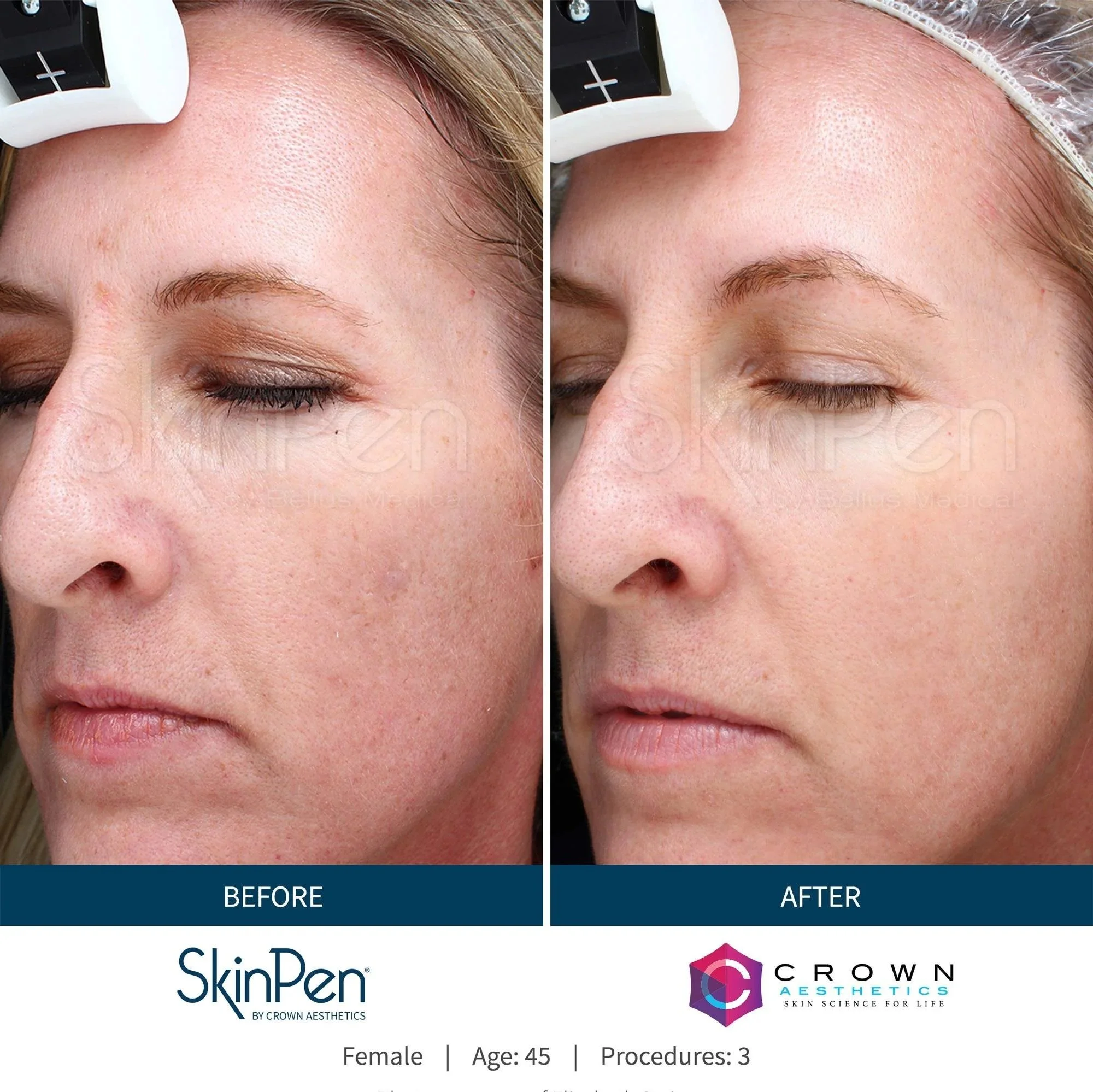 Before and after image SkinPen microneedling at Buff Aesthetics in Tiffin, Ohio
