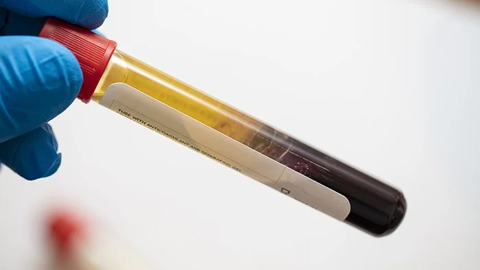 PRP treatments at Buff Aesthetics in Tiffin, Ohio