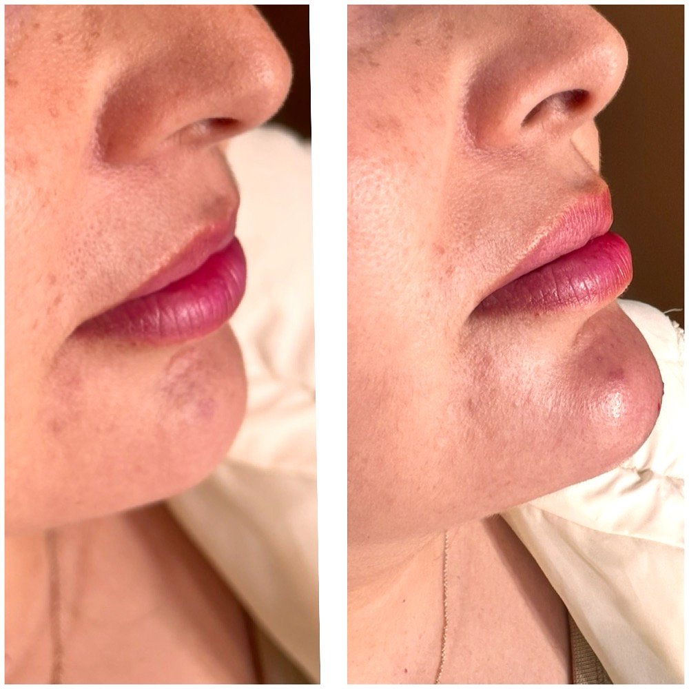 Close-up side-by-side comparison of a person's lips before and after cosmetic enhancement, showing fuller lips in the right image.