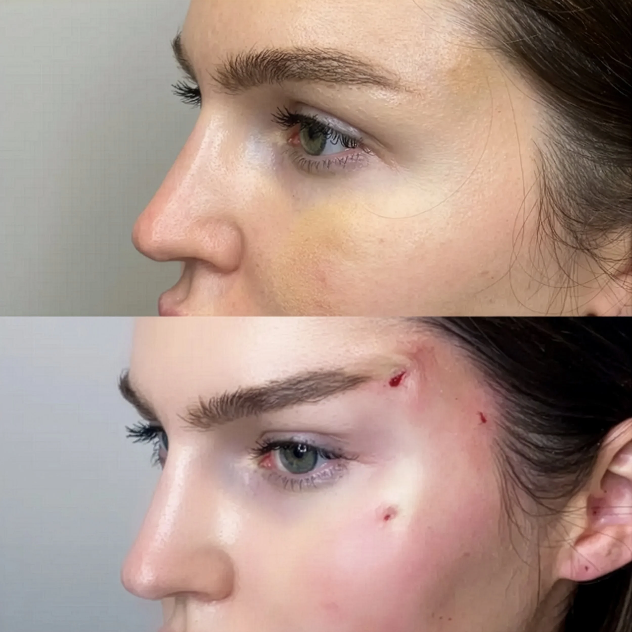 Close-up side view of a woman's face showing a before and after medical procedure, with minor injuries in the 'after' image.