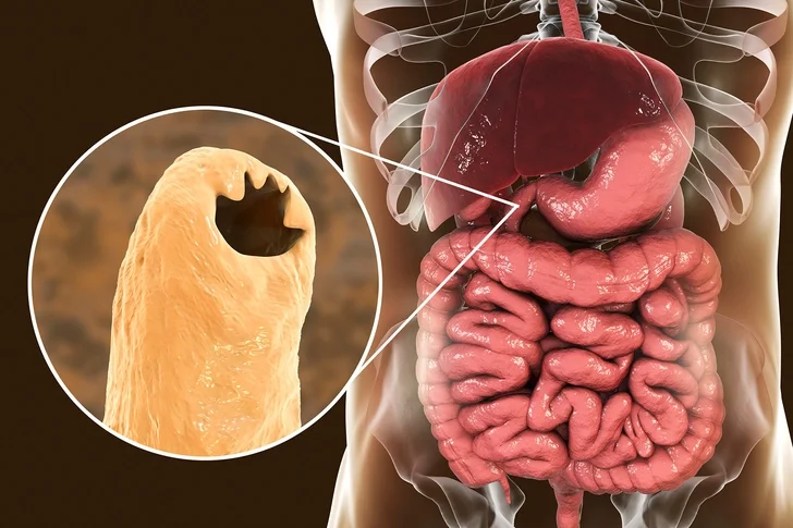 An anatomical illustration showing the human digestive system with a focus on the stomach and intestines, and a magnified view of a parasite, likely a helminth, attached to the intestinal lining.