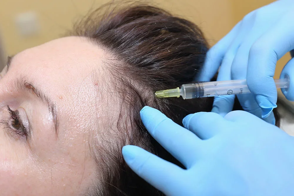 A person receiving a cosmetic treatment on their scalp with a syringe, while lying down and wearing blue gloves.
