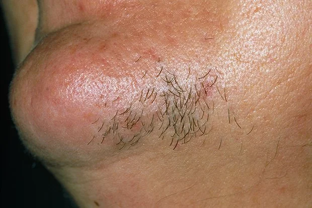 Why Woman Get Unwanted Facial Hair: Causes, Hormones &amp; Permanent Solution