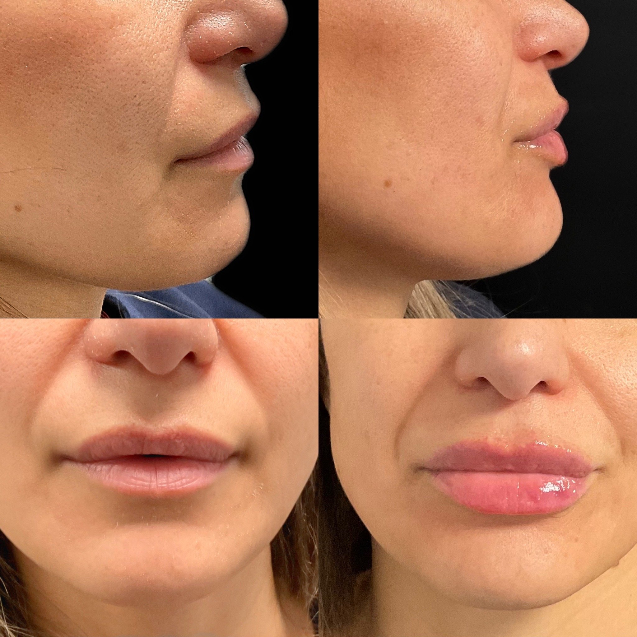 Close-up of a woman's face in four different views showing before and after cosmetic or skincare treatments, focusing on lips, cheeks, and jawline.