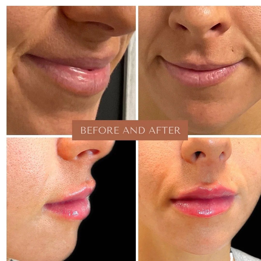 Close-up images showing before and after results of lip enhancement, with the top left and bottom left photos focusing on lips from different angles, and the top right and bottom right photos showing front views of the face with improved lip appearance.
