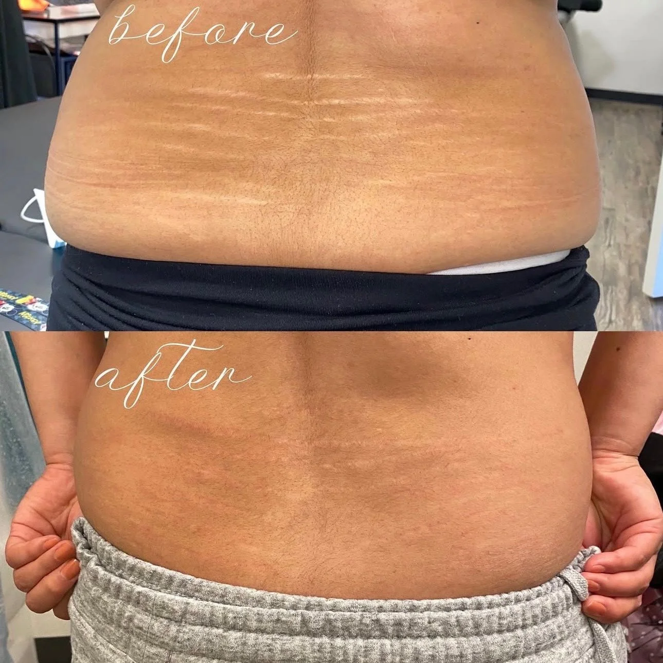 Comparison of a person's lower back and waist area before and after body contouring or weight loss; the 'before' shows a larger, more rounded waist, while the 'after' shows a slimmer, more toned waist.