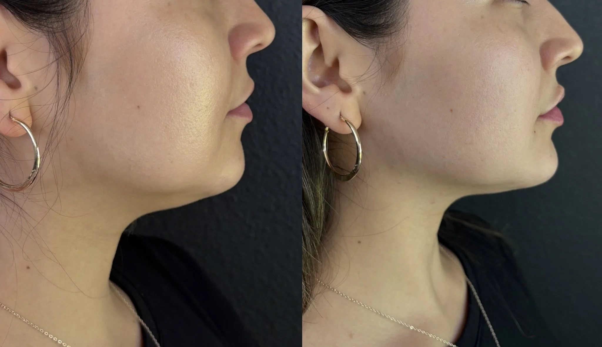 Comparison of side profile of woman's face showing skin before and after skin treatment, with a black background.