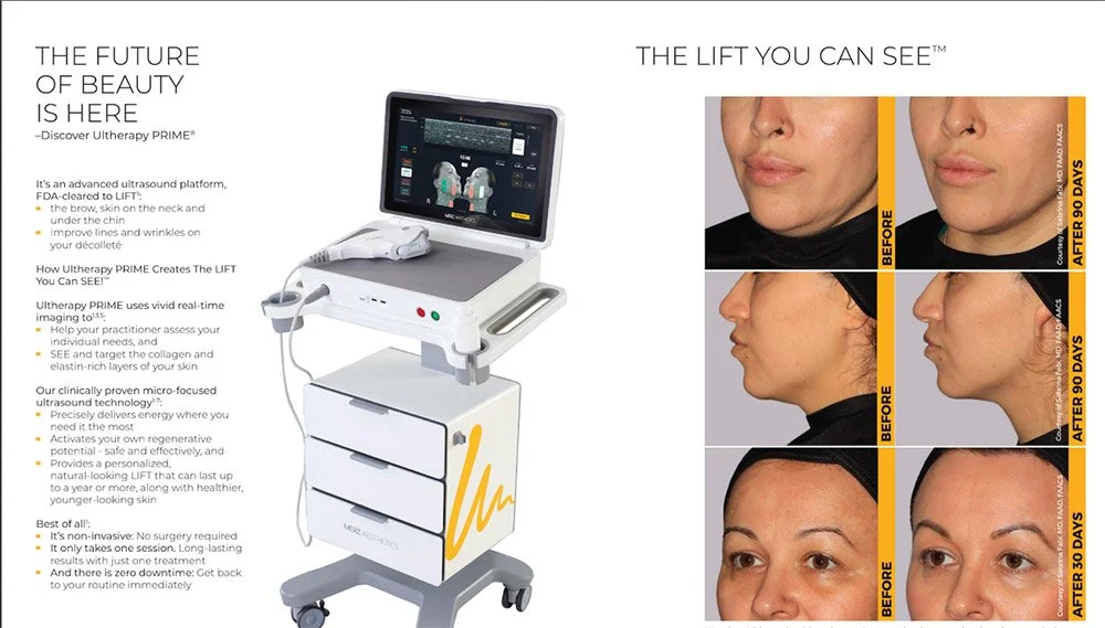 Ultherapy Lift
