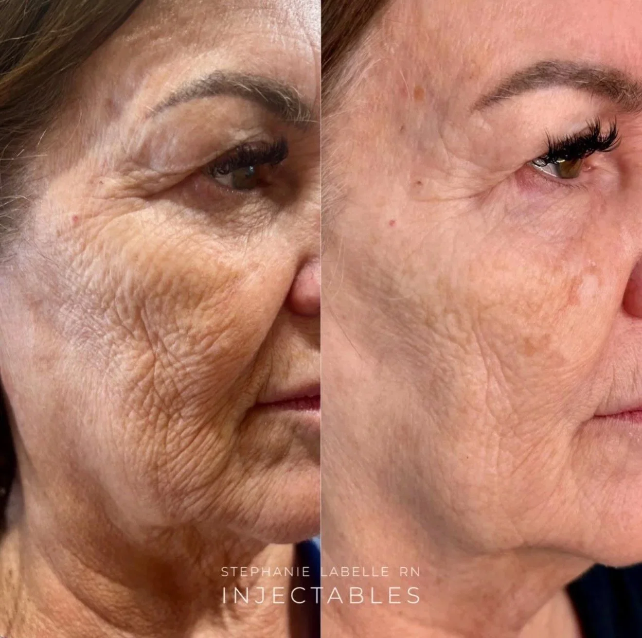 What does sculptra actually do? a research based look at how it works