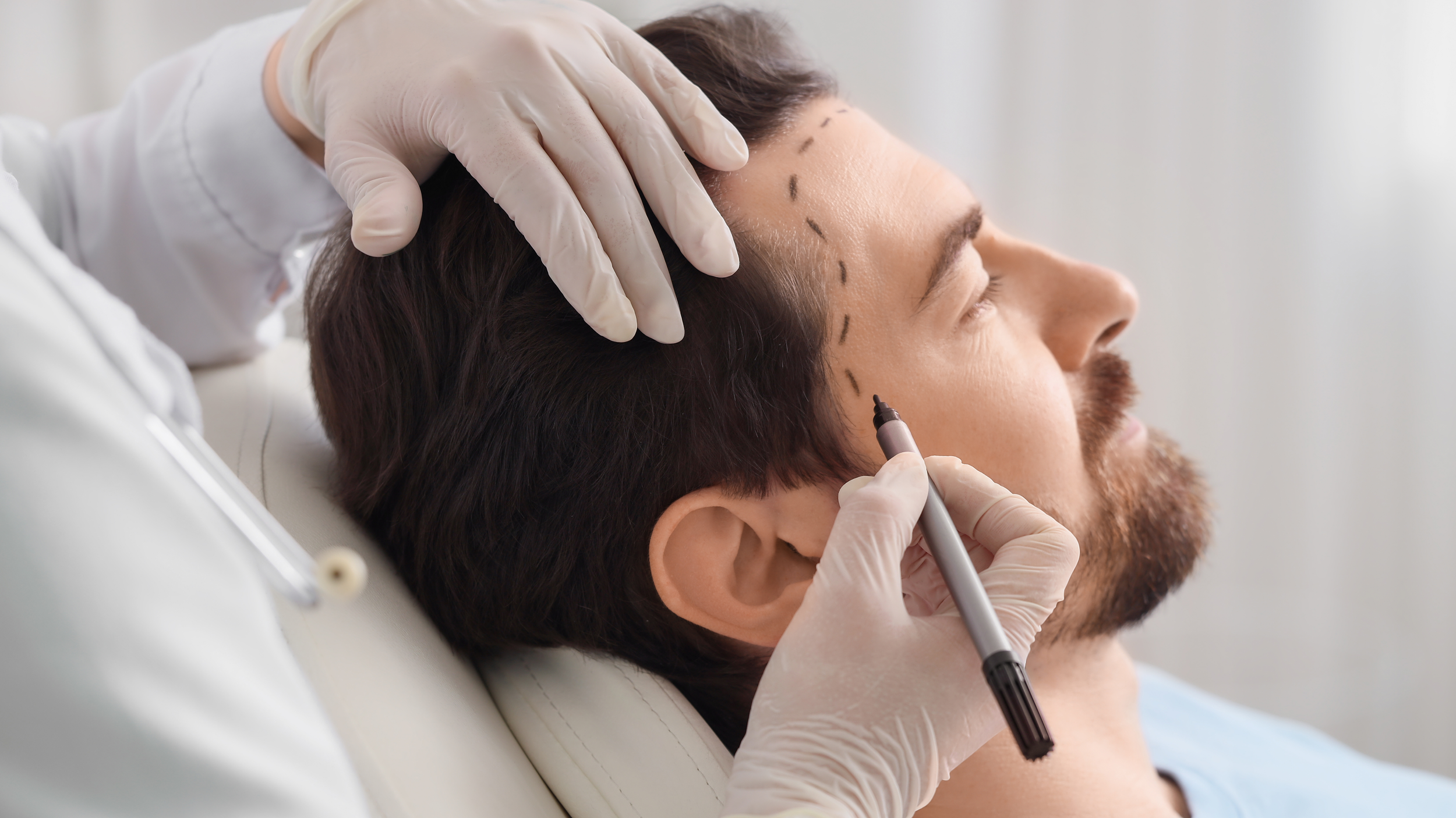 Medical professional drawing dotted lines on a man's forehead in preparation for a cosmetic procedure.