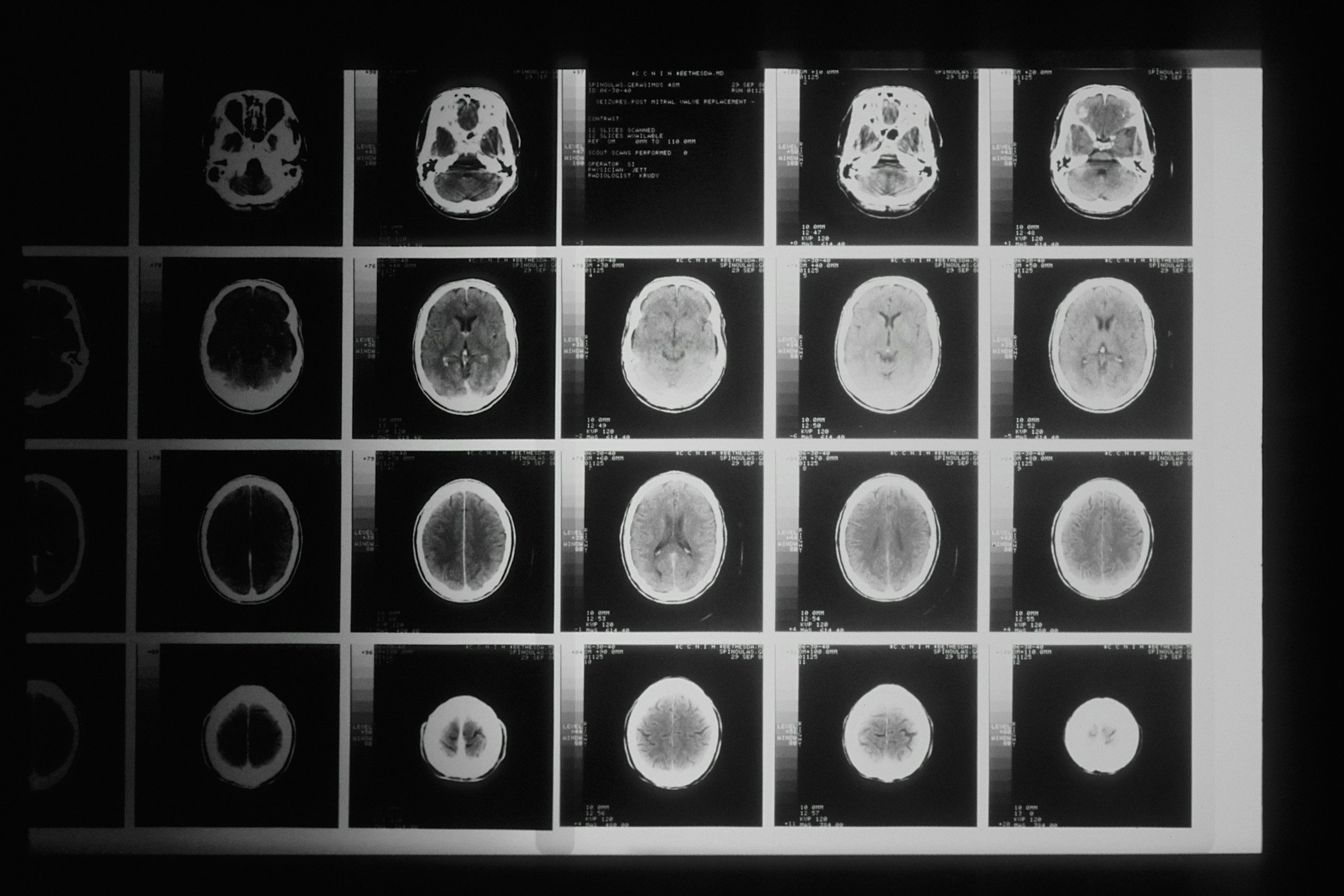 Black-and-white photograph of multiple slices of a brain scan displayed on a lightbox.