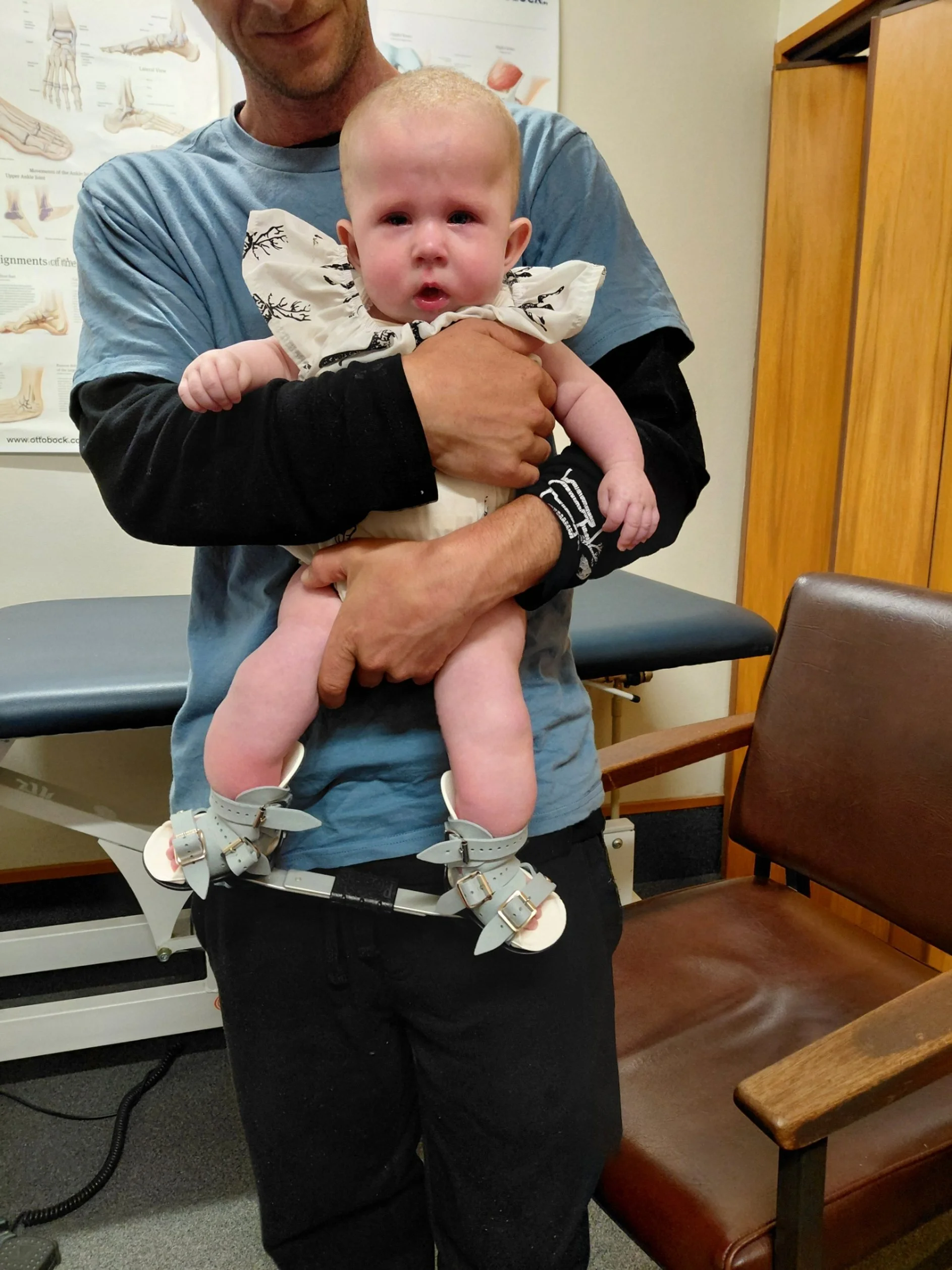hannah-rose right after boots and bars fitted clubfeet arthrogryposis