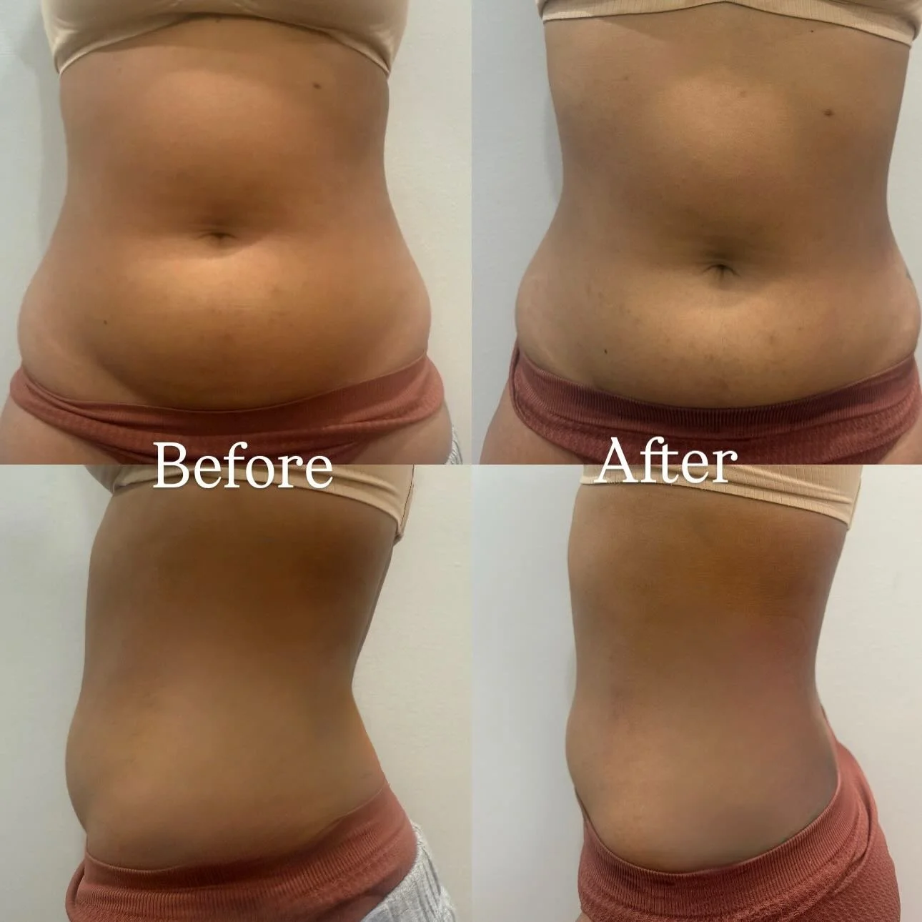 &mdash; READ THIS: Detox &rarr; Breakdown &rarr; Sculpt: The Start of Her Snatched Era ✨

This client came in with stubborn fat around the hips and lower abdomen &mdash; that deep pocket below the belly that&rsquo;s notoriously hard to target.
So ins
