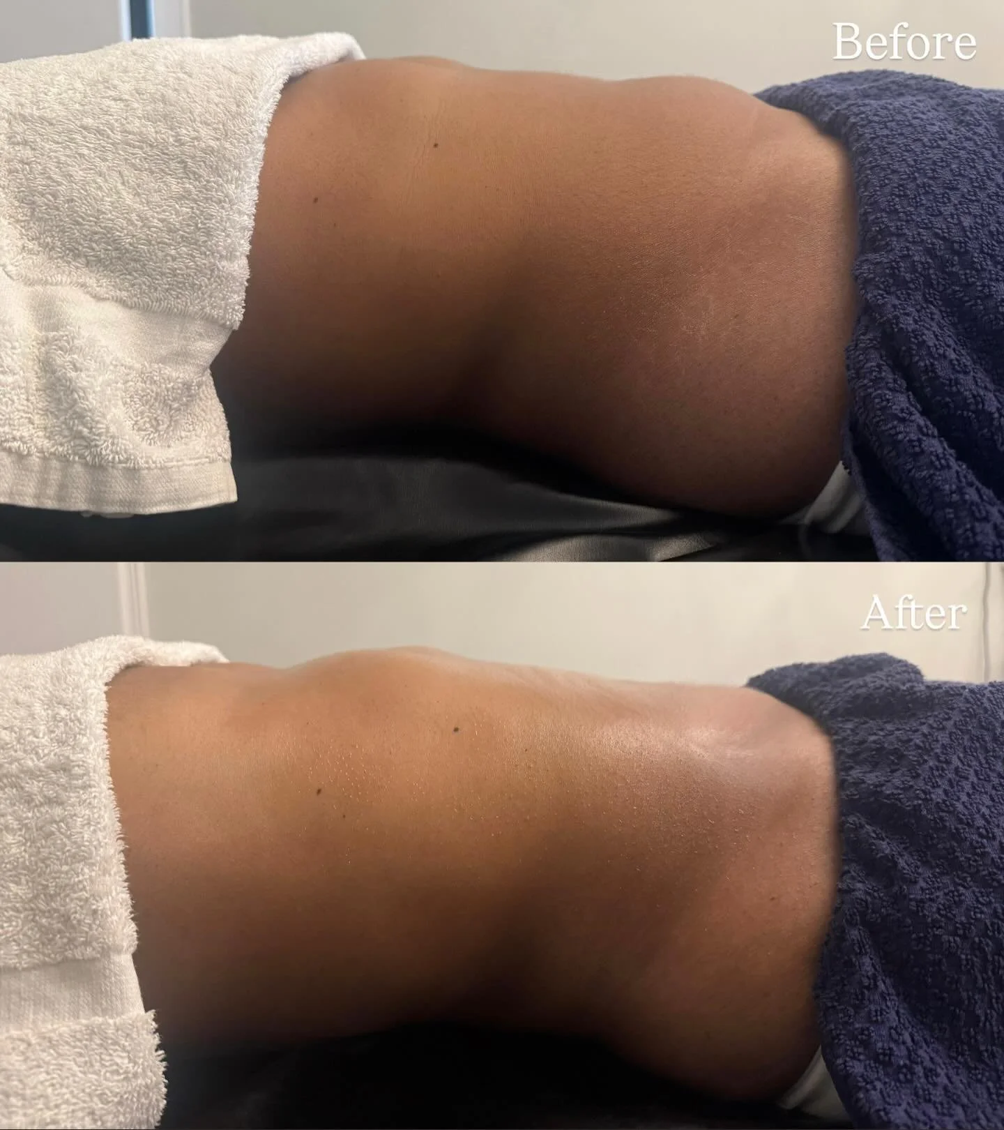 - Why BLD should be a part of your routine as you get older: 

As we get older, our lymphatic system naturally slows down &mdash; which means more bloating, inflammation, puffiness and stubborn water retention.
This is why adding Brazilian Lymphatic 