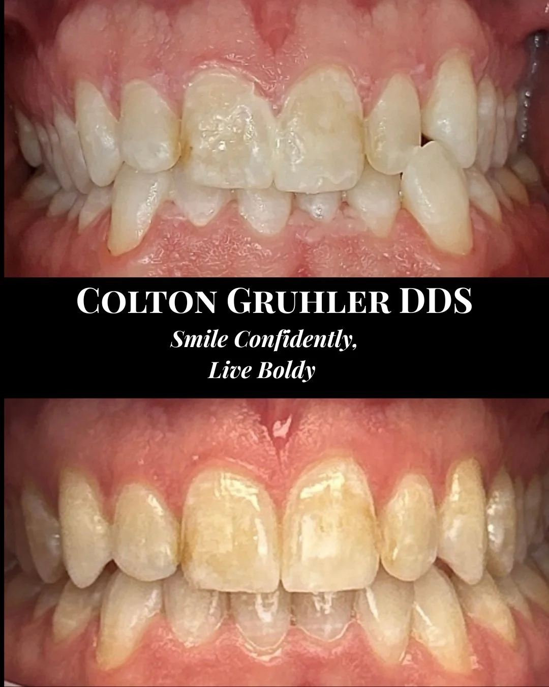 Coltons Invisalign ONE AND DONE.jpeg