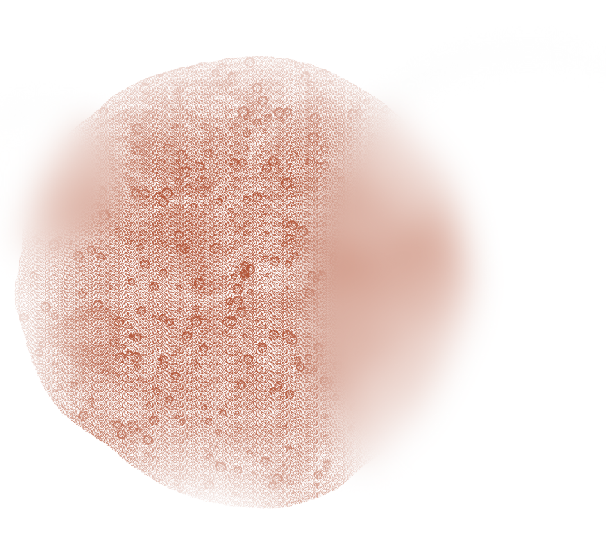 Close-up of a person's chin with a red, inflamed rash or skin condition containing small bumps and spots.