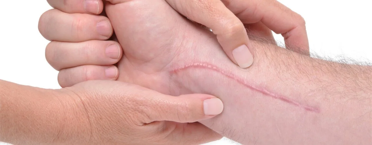 Scar Mobilization: Restoring Movement, Sensation, and Ease After Surgery