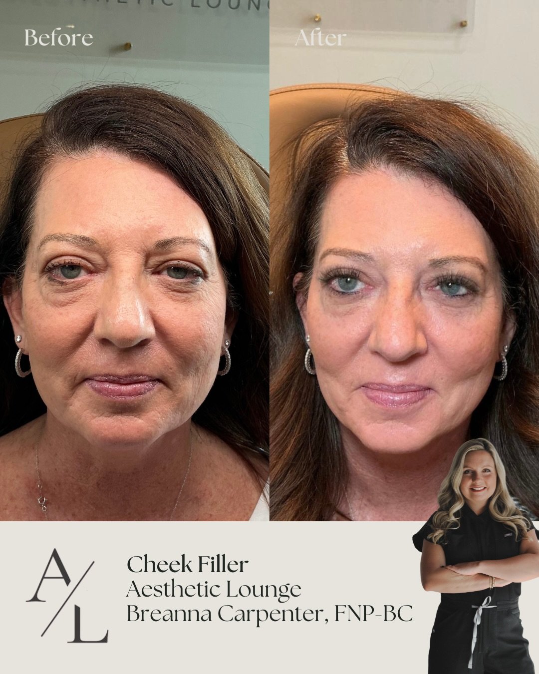 A little filler, a lot of confidence 💉💋

If you&rsquo;ve been waiting for a sign to get filler, this is it. Visit us this Saturday, February 21st, for our Grand Opening from 1-4pm! We&rsquo;ll be having exclusive specials and giveaways that you do 