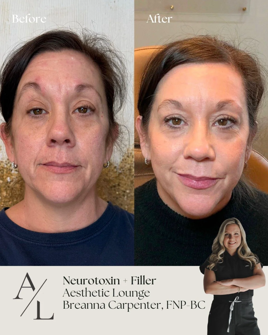 At The Aesthetic Lounge, our before &amp; after results with tox + filler are all about softening lines while keeping your natural expression intact.

Long-lasting results &amp; minimal downtime 💉

Ready for your appointment? Click the link in our b
