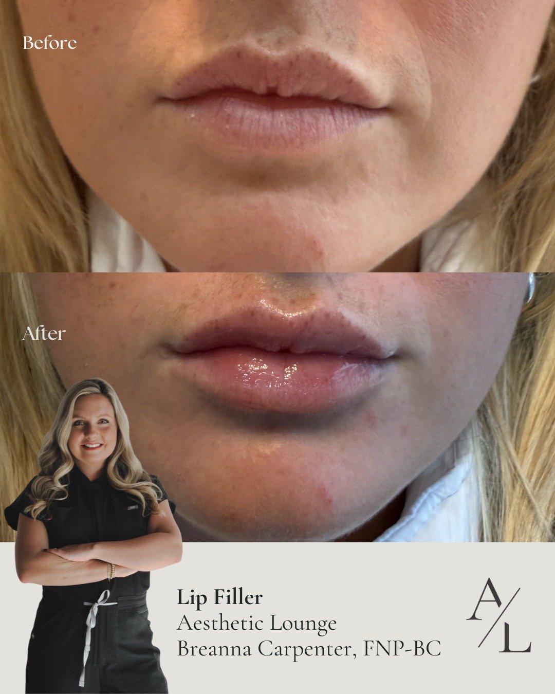 The perfect pout 💋✨

At The Aesthetic Lounge, our lip filler treatments are designed to add subtle volume, balance, and a natural-looking finish.

Ready for your dream lips? Click the link in our bio to book.

#LipFiller #PerfectPout #KnoxvilleMedSp