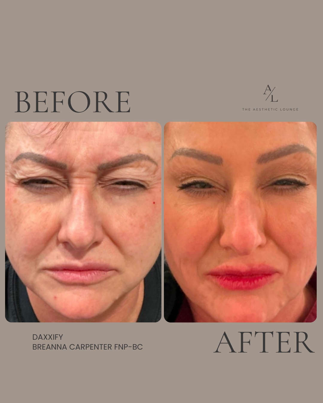 Side-by-side comparison of a woman's face before and after cosmetic treatment, showing reduced wrinkles and smoother skin.
