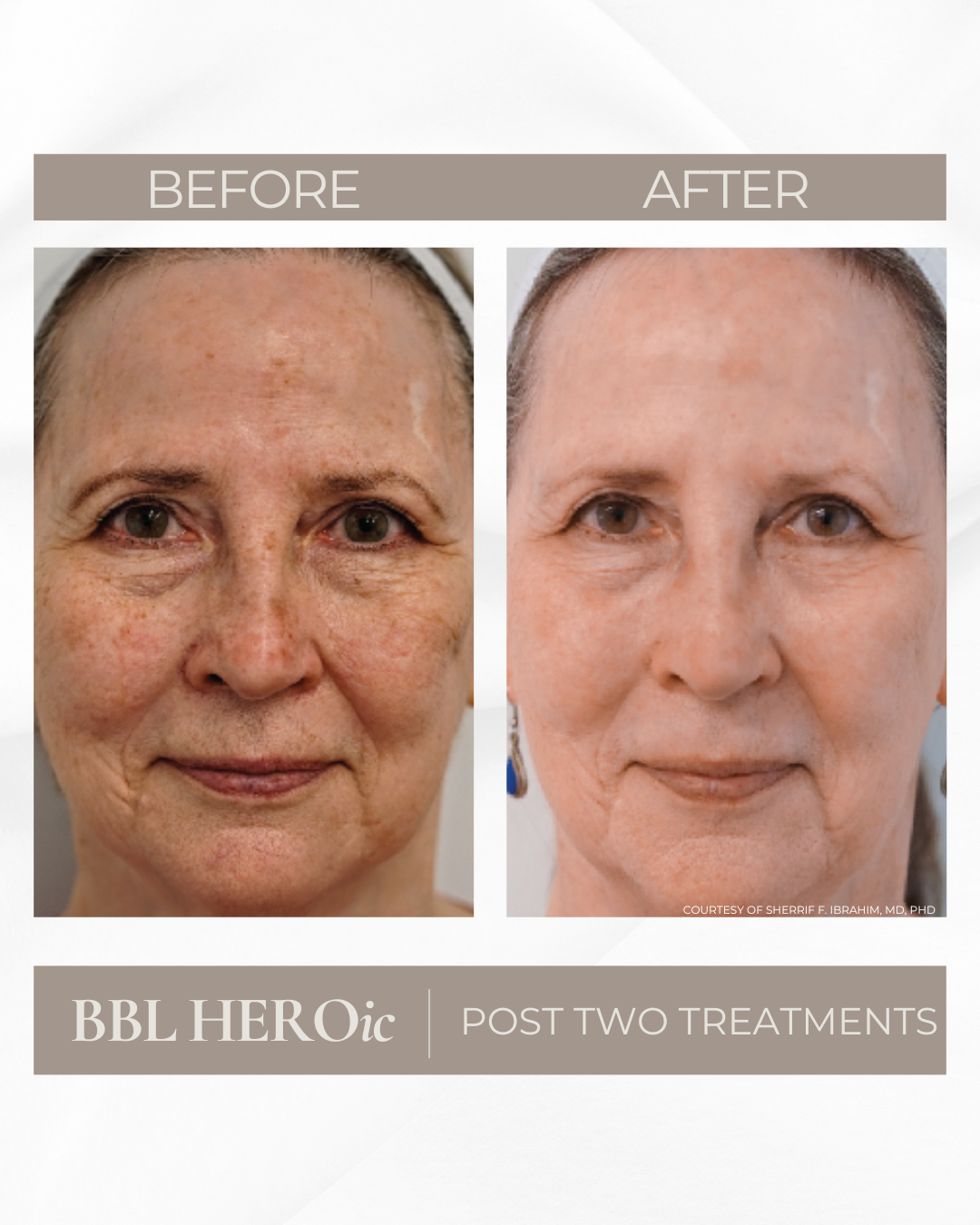 Side-by-side comparison of a woman's face showing before and after skincare treatment, highlighting improvements in skin clarity, texture, and appearance.