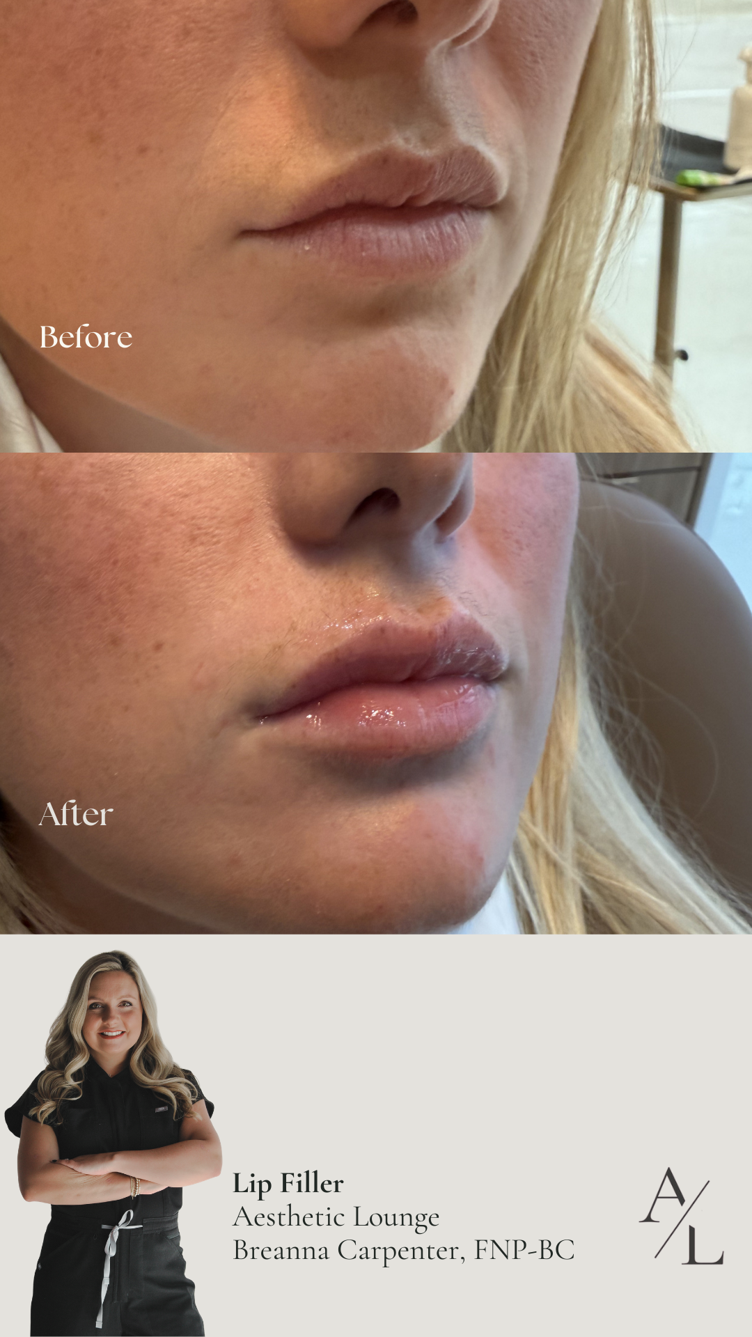 Side-by-side comparison of a woman's face before and after cosmetic treatment, showing reduced wrinkles and smoother skin.