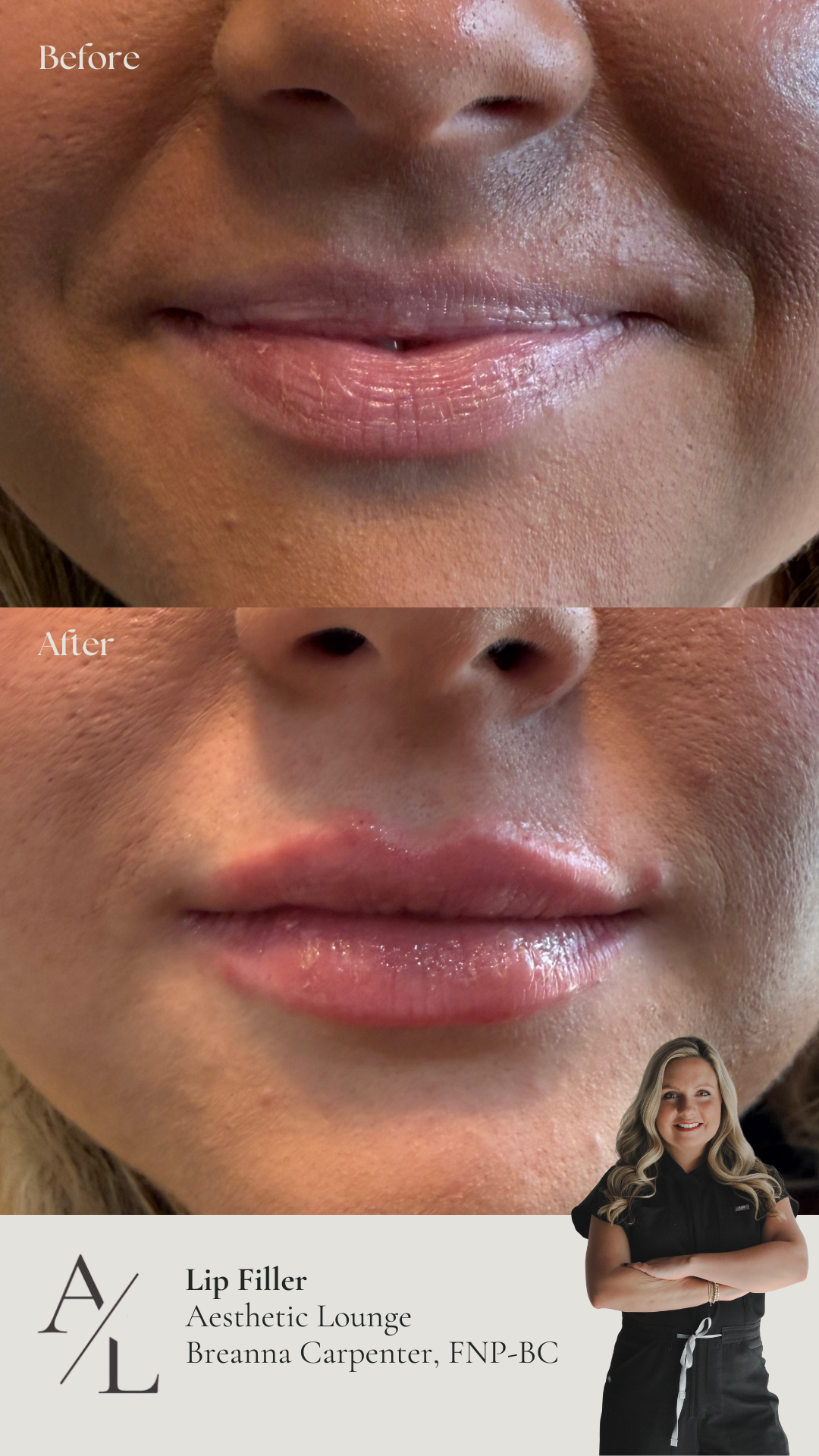 Side-by-side comparison of a woman before and after cosmetic treatment showing improved skin texture and youthful appearance.