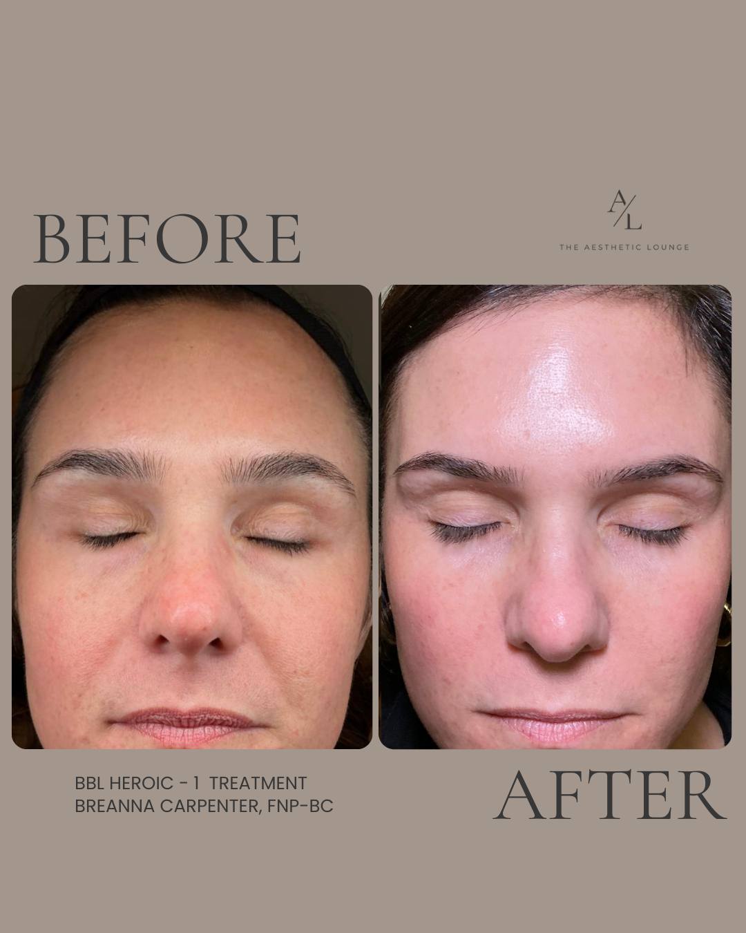 Side-by-side comparison of a woman's face before and after a skincare treatment, showing clearer and smoother skin post-treatment.