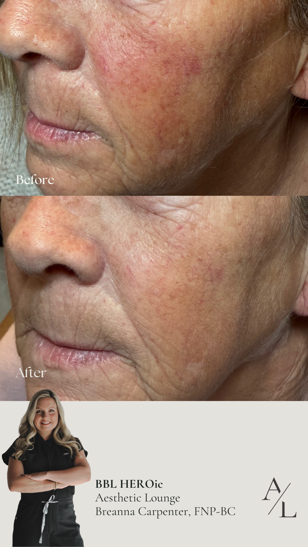Side-by-side before and after images of an older woman's face showing skin improvements after two treatments, with text indicating 'BEFORE' and 'AFTER' and mentioning 'BBL HEROic POST TWO TREATMENTS.'