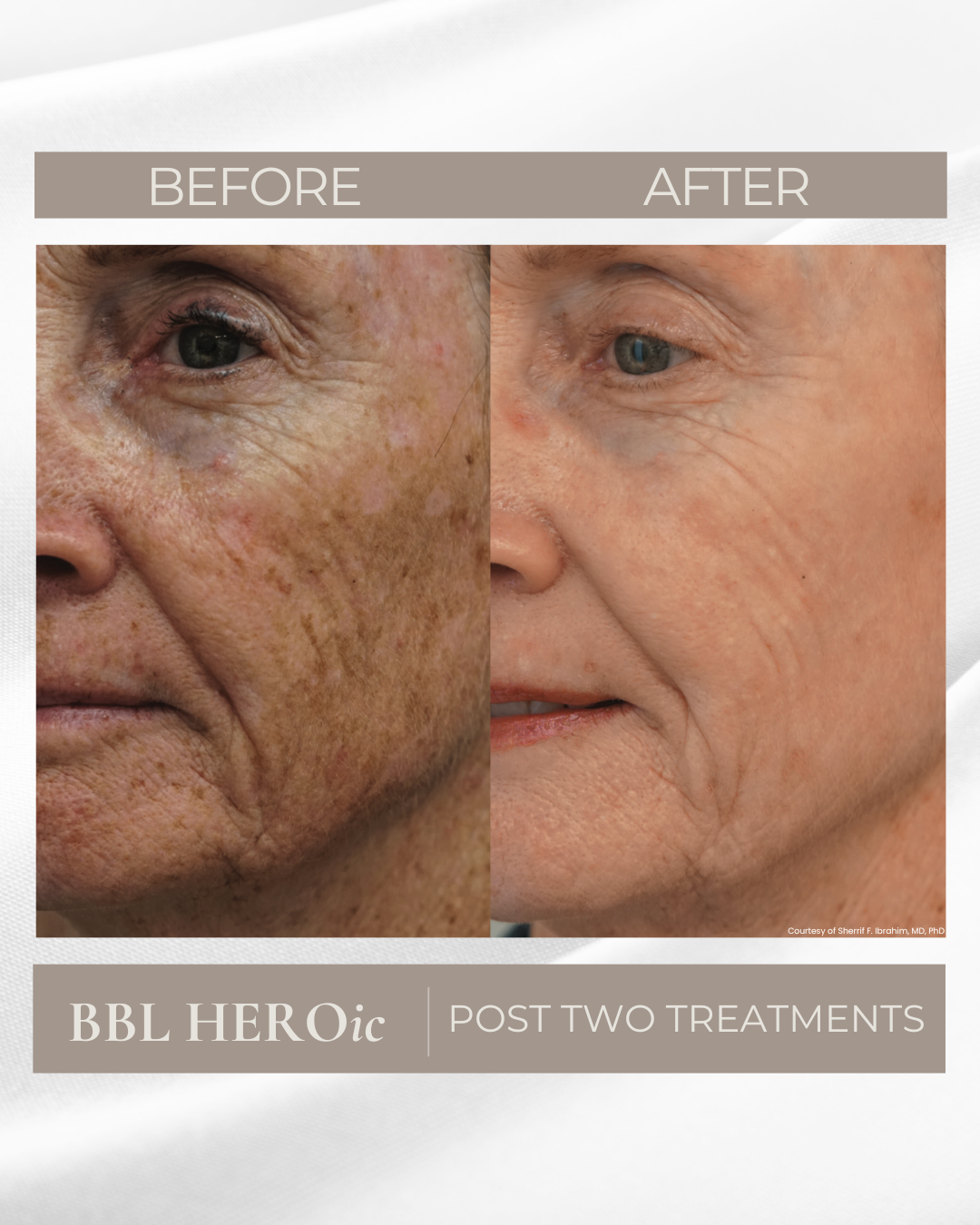 Side-by-side before and after images of an older woman's face showing skin improvements after two treatments, with text indicating 'BEFORE' and 'AFTER' and mentioning 'BBL HEROic POST TWO TREATMENTS.'