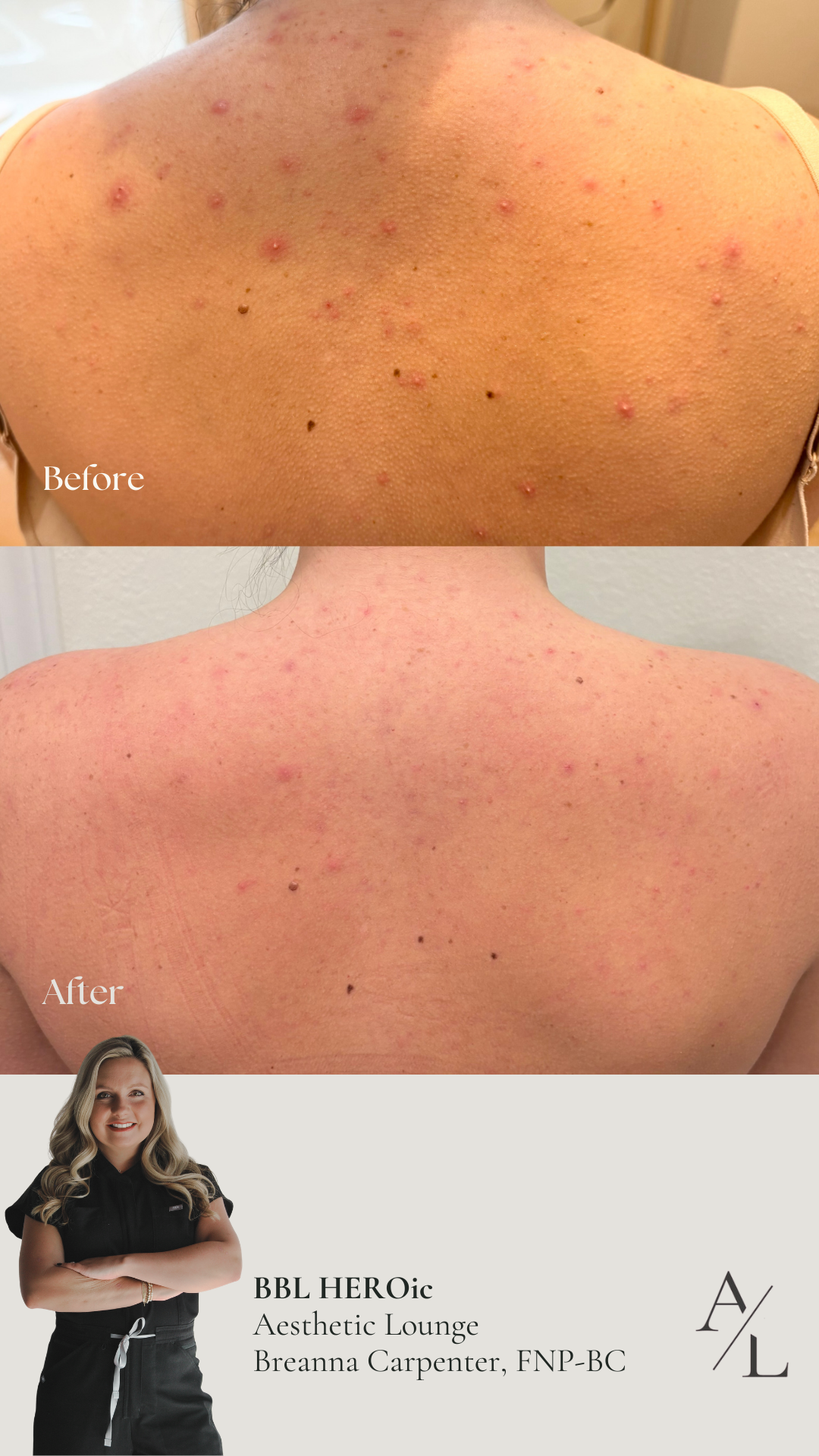 Side-by-side comparison of a woman's face before and after a skincare treatment, showing clearer and smoother skin post-treatment.