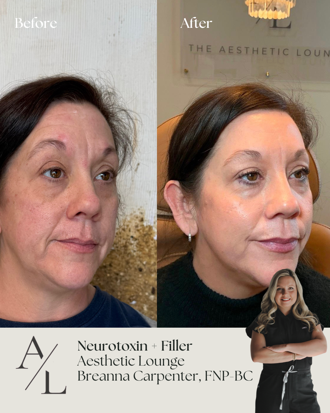 Side-by-side comparison of a woman's face showing before and after skincare treatment, highlighting improvements in skin clarity, texture, and appearance.
