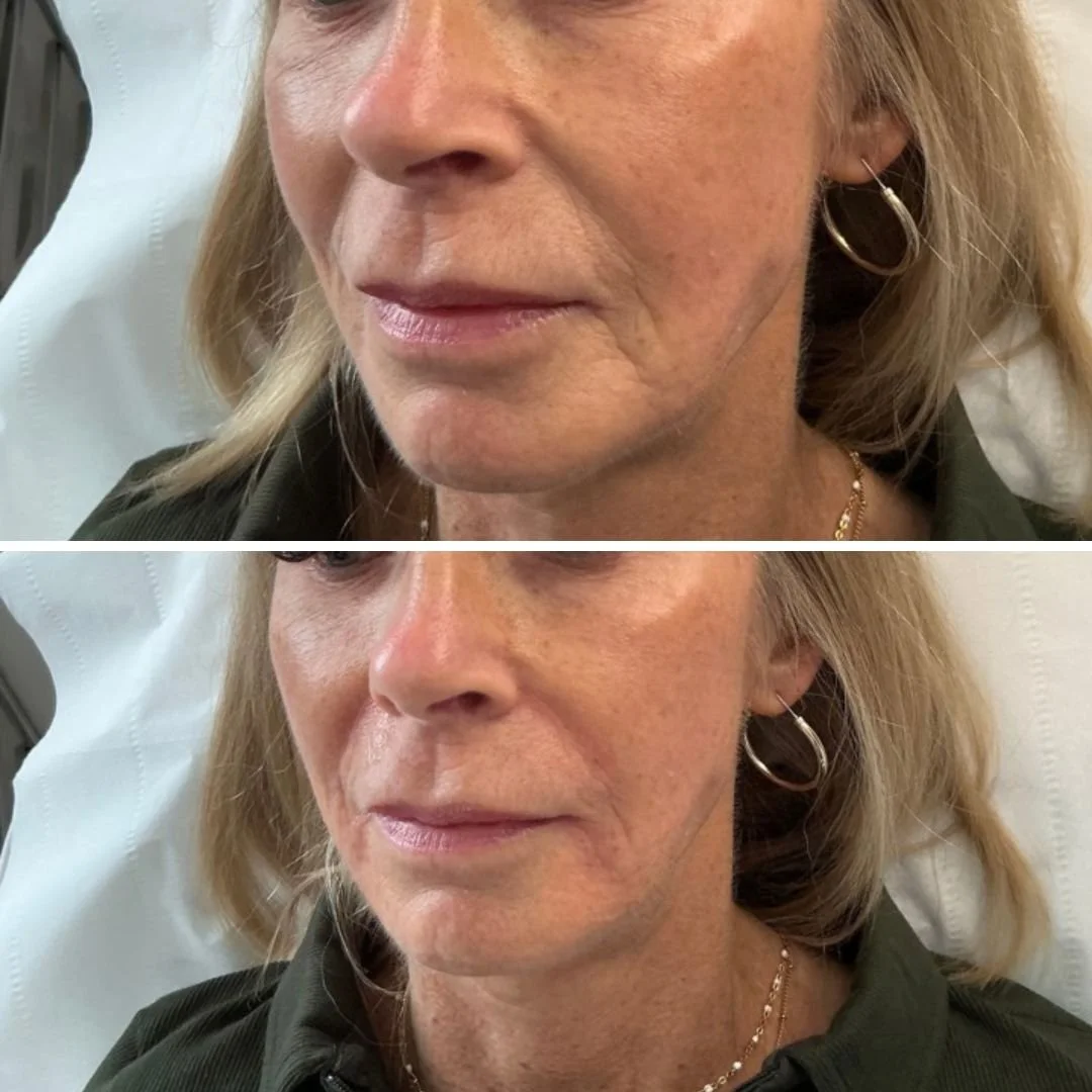 Client receiving a medically led aesthetic treatment at Natasha Holden Aesthetics.