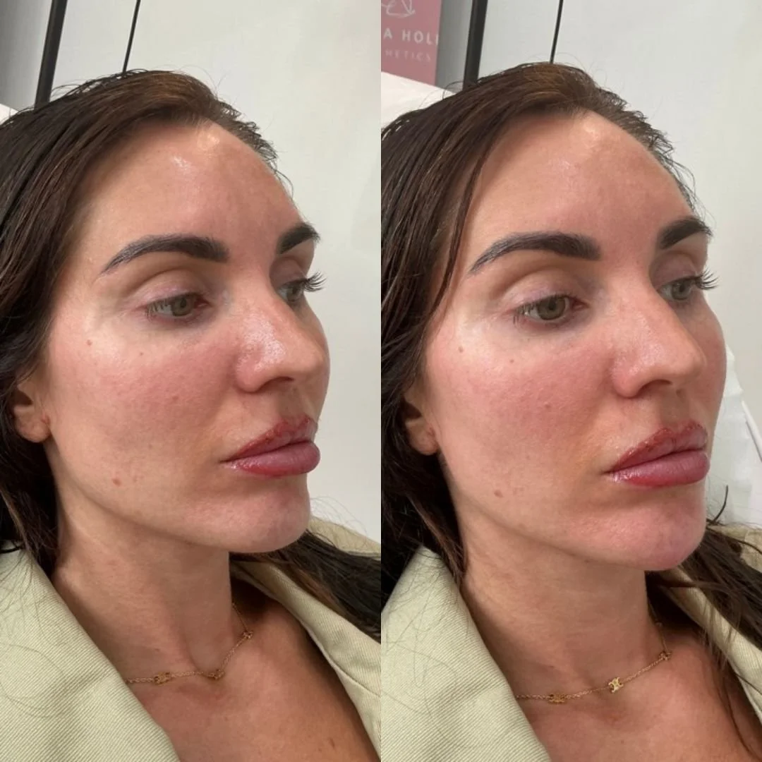 Wrinkle-relaxing injections delivered with care and accuracy at Natasha Holden Aesthetics.