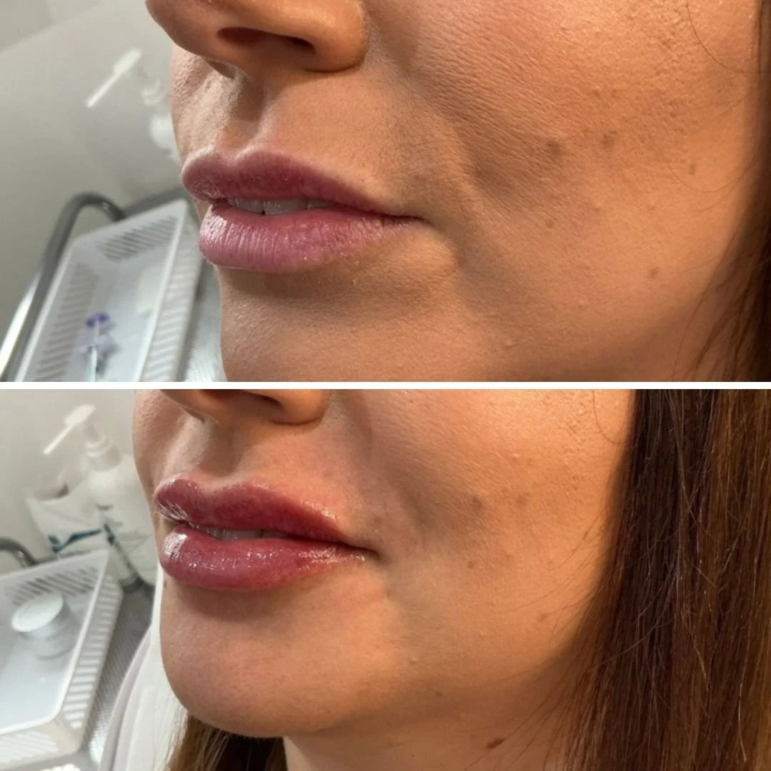Close-up of a woman's lips before and after cosmetic lip enhancement, showing increased volume and shinier appearance in the after photo.
