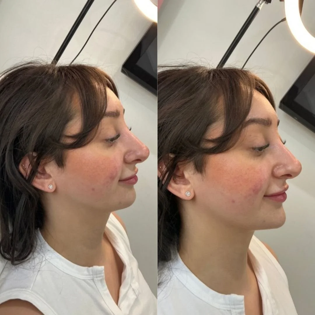 Side-by-side comparison of a woman's profile before and after a skincare treatment, showing improved skin clarity and texture.