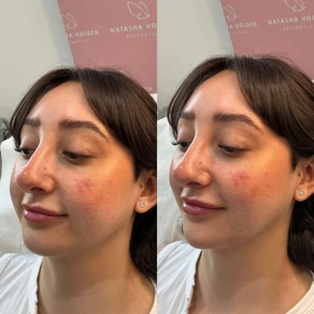 A side-by-side comparison of a woman's face showing skin before and after skincare treatment, with a pink background featuring a logo and text for Natasha Holden Aesthetics.