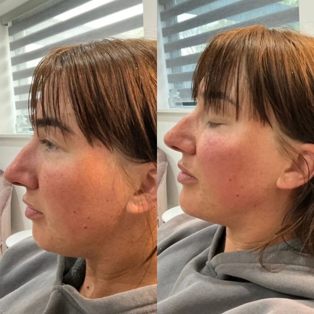 Application of dermal filler treatment with professional clinical technique.